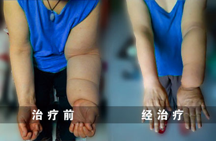 案例分享：乳腺癌术后5年、上肢淋巴水肿的治疗