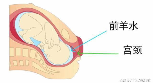 顺产破水来临时，准爸准妈如何应对？