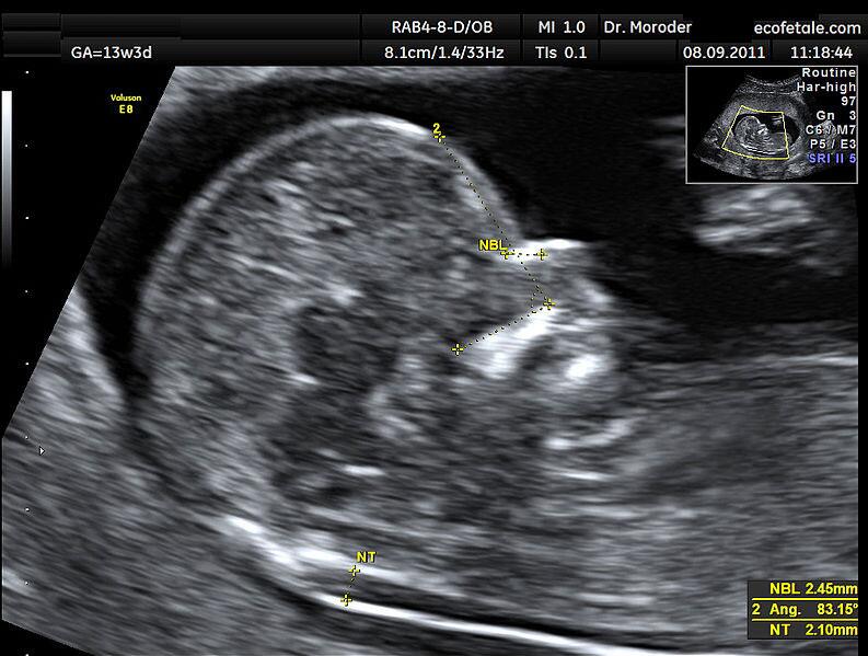 nt检查是看啥,nt检查是查胎儿什么疾病的