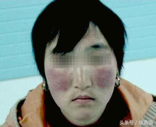 脸蛋红是心脏病的征兆,心脏导致脸发红的症状