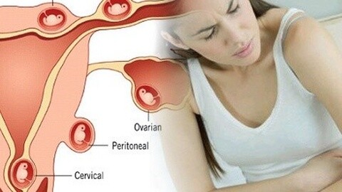 有哪些病史的容易出现宫外孕,早期发现宫外孕一定要手术吗