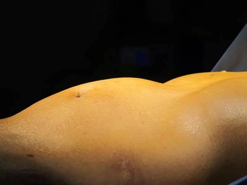 腹主动脉瘤腔内修复术多少钱,腹主动脉瘤怎么自测