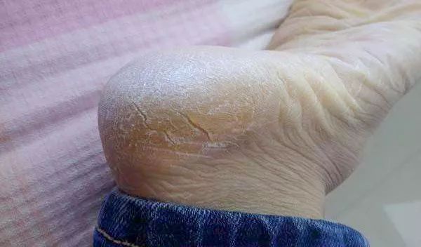 糖尿病脚底干裂,脚底干裂修脚刀