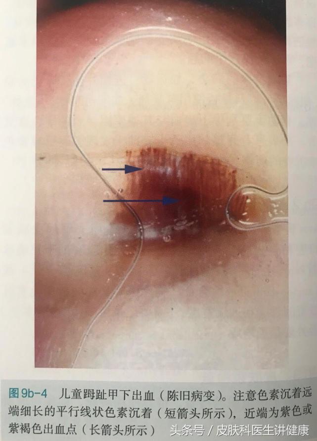 甲下黑色素瘤会不会指甲一夜变黑,指甲发黑是大脑血管有杂质吗