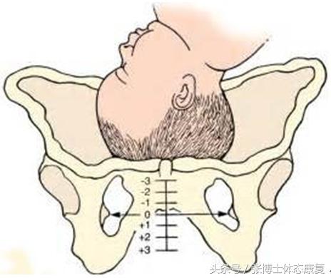 孕期耻骨疼康复理疗,孕期运动疗法图片