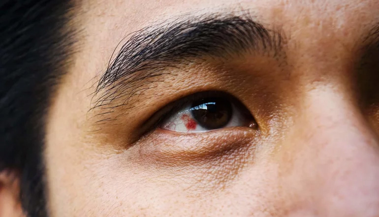 眼睛变红快速治疗方法,眼睛变红的小技巧