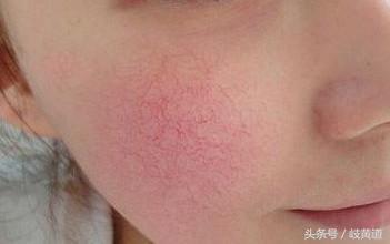 脸蛋红是心脏病的征兆,心脏导致脸发红的症状