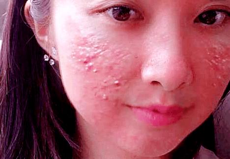 芦荟胶皮炎可以用吗,激素依赖性皮炎能用完美芦荟胶吗