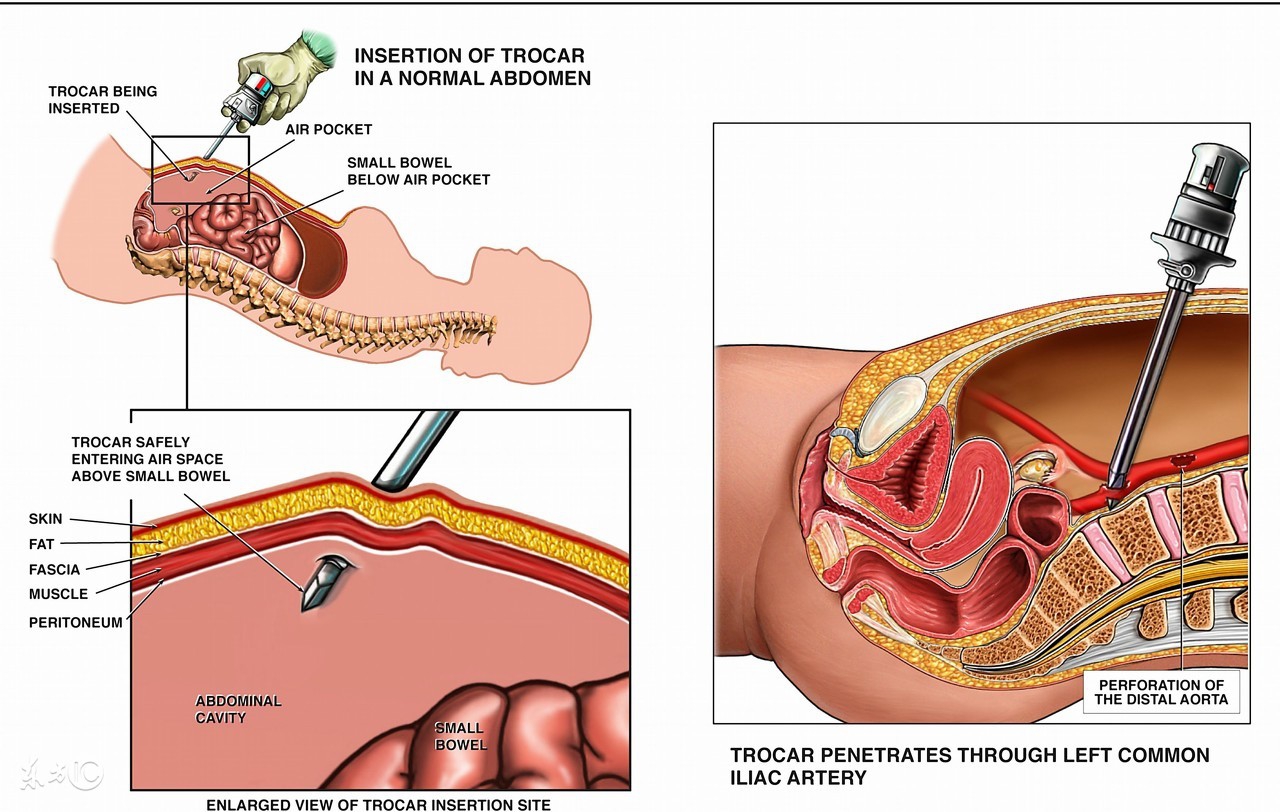 阿司匹林副作用人人都会有吗,阿司匹林不适合哪些人群