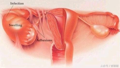 盆腔炎经常左下腹疼痛是什么原因,下腹疼痛异常当心盆腔炎