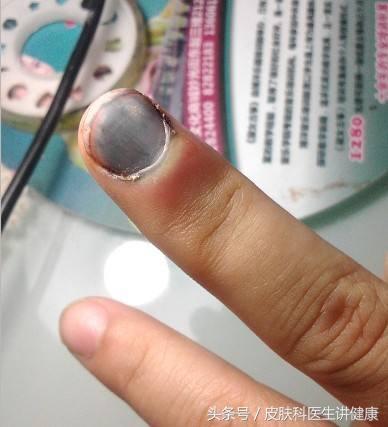 甲下黑色素瘤会不会指甲一夜变黑,指甲发黑是大脑血管有杂质吗