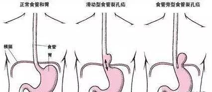 天气再冷，过烫的食物也别急着吃，一不小心就……