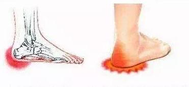 脚后跟痛的中医病机,中医脚后跟痛是什么原因引起的