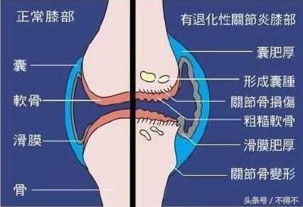 肥胖导致关节炎原因,肥胖为什么易得关节炎
