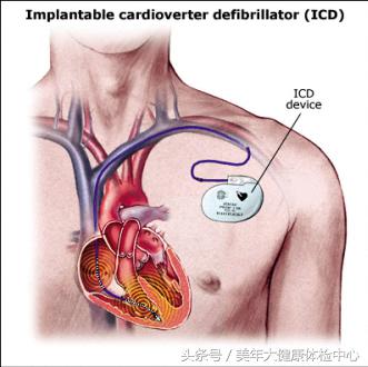 心衰患者icd植入适应症,中国需要器官移植的病人有多少