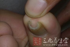 如何从指甲检查出身体状况,怎样通过指甲了解健康状况