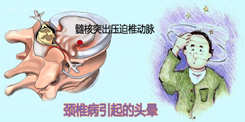 这些症状在提醒你可能患上颈椎病,颈椎病可能引发8大危险症状