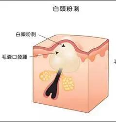 脸上有小疙瘩小颗粒解决办法,脸上小疙瘩怎么处理