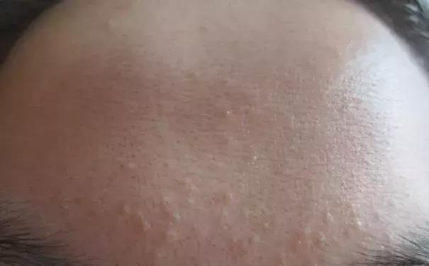 脸上有小疙瘩小颗粒解决办法,脸上小疙瘩怎么处理