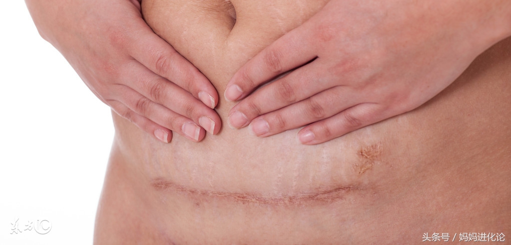 剖腹产第一天如何护理,剖腹产后第一天怎么护理