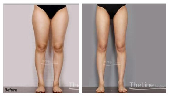 双腿之间赘肉横生，腿粗比腿细的更矮，6套动态图实力教学来瘦腿