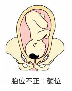 产妇胎位不正医生纠正难产完整版,孕妇胎位不正什么原因导致的