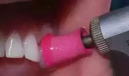 儿童牙齿黑乎乎的,孩子牙齿里面黑黑的怎么回事