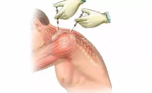 肩疼膀子疼去医院挂什么科,颈椎疼和肩疼会引起其它什么病