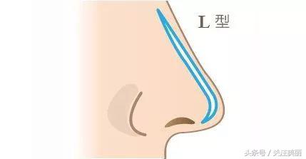 隆鼻后鼻子红肿怎么回事,隆鼻后鼻子肿胀是怎么回事