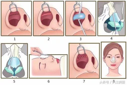 隆鼻后鼻子红肿怎么回事,隆鼻后鼻子肿胀是怎么回事