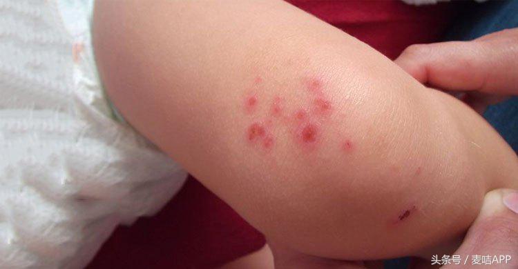 妈妈做对３件事，宝宝用多效修复凝胶湿疹不再来！