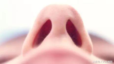 隆鼻后鼻子红肿怎么回事,隆鼻后鼻子肿胀是怎么回事