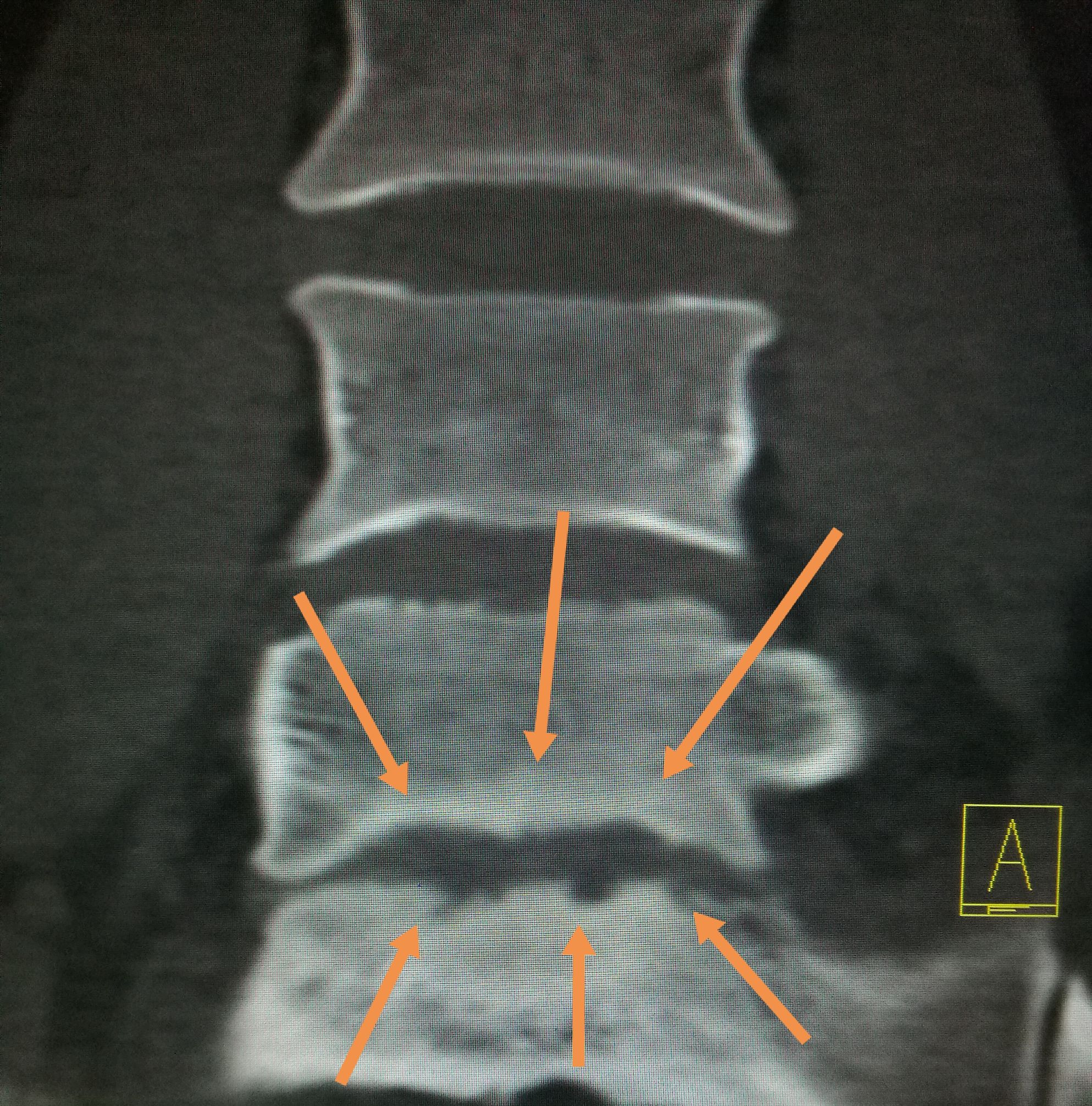 吃羊肉腰胀疼是怎么了,经常吃牛羊肉身体有啥变化