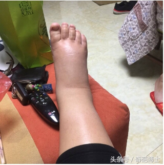 孕晚期水肿和羊水过少有关吗,孕期水肿得厉害怎么缓解