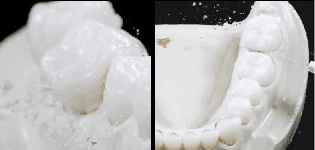 洗牙有什么副作用吗,洗牙怎么不伤牙