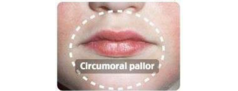 猩红热颜色,猩红热又开始了吗