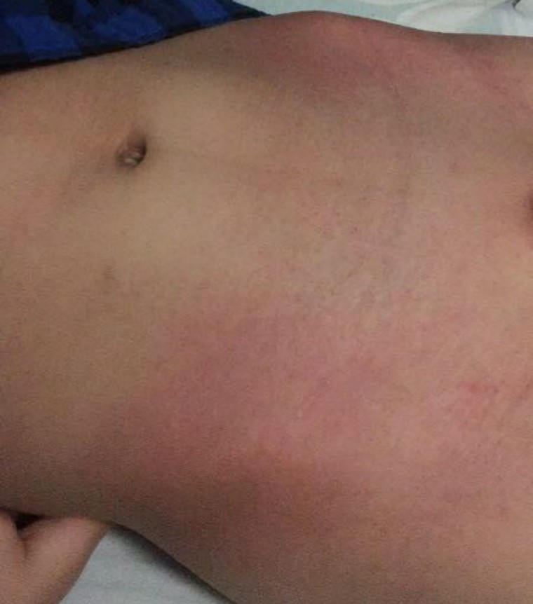 猩红热颜色,猩红热又开始了吗