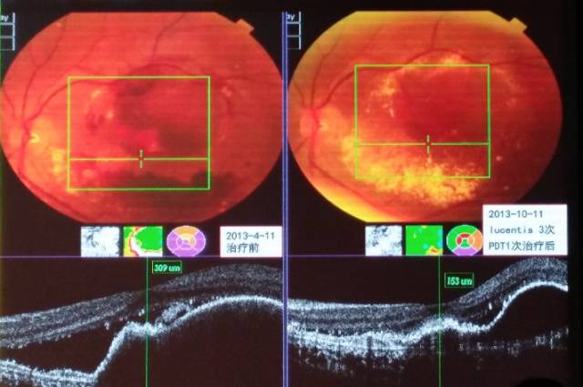 黄斑病变的克星,得了黄斑病变需要忌什么食物