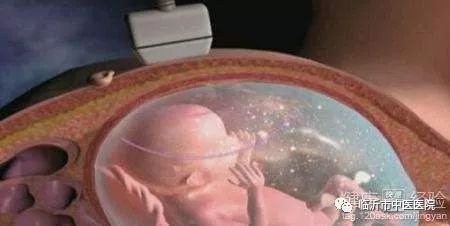 羊水早破中医治疗,中医认为羊水早破