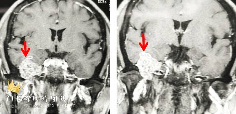 烦人的耳鸣,烦人耳鸣