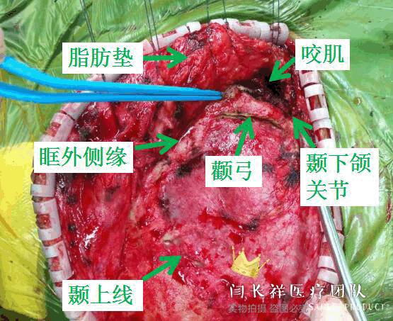 烦人的耳鸣,烦人耳鸣