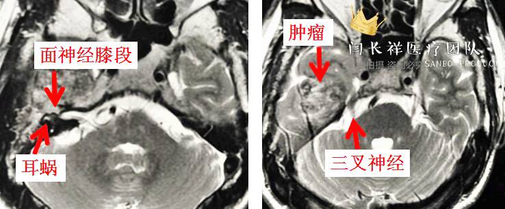 烦人的耳鸣,烦人耳鸣