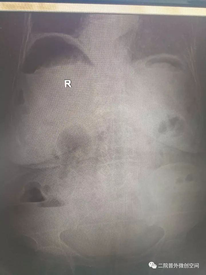 「病人故事」耄耋胃穿孔老人经微创手术治疗后今天痊愈出院啦！这个疾病很凶险，常吃止痛药的朋友要关注哦！