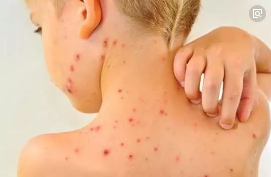 今年水痘频发怎么回事,近期水痘高发怎么回事