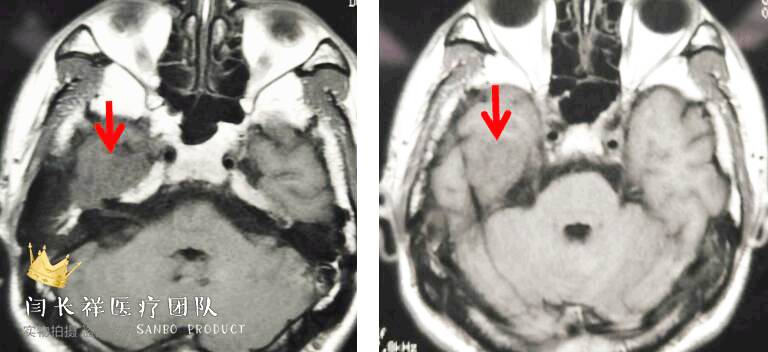 烦人的耳鸣,烦人耳鸣
