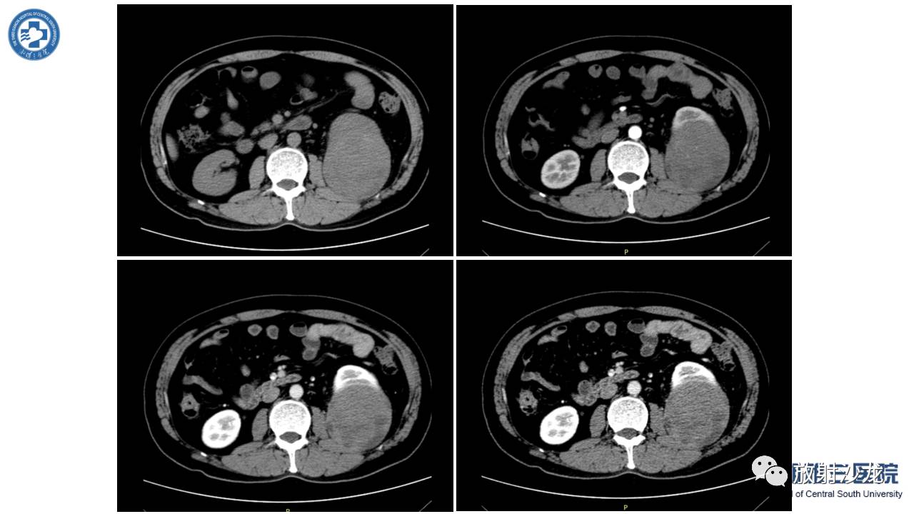 「每日一例｜489例」男，左侧腰部撞伤后疼痛3月
