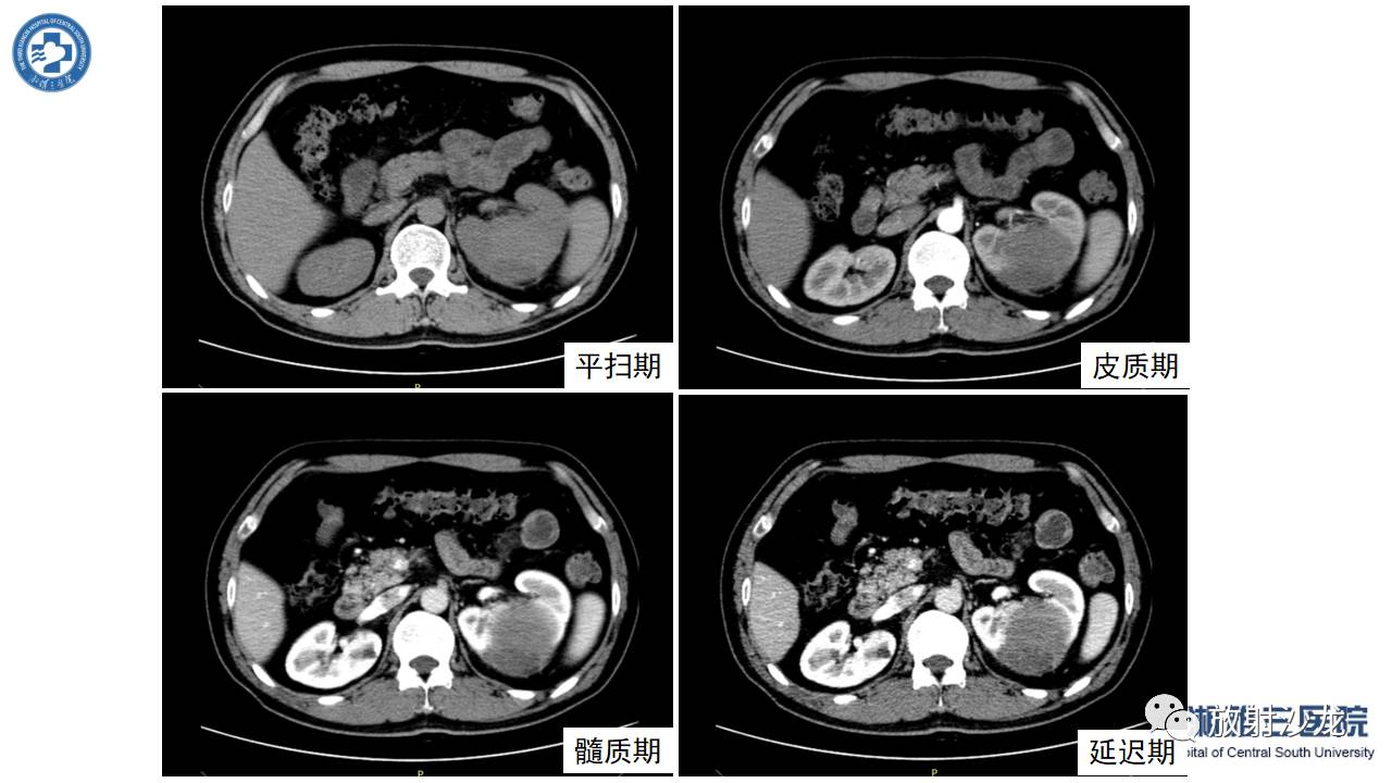 「每日一例｜489例」男，左侧腰部撞伤后疼痛3月