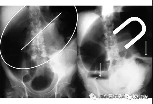 详细腹部平片解剖+正常表现+读片技巧+病例分析