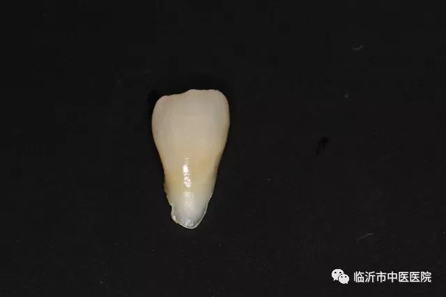 北京口腔医院可以接断牙吗,牙科断牙怎么补救