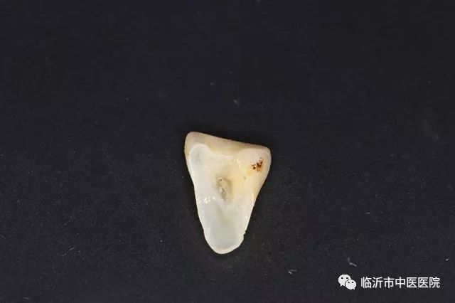 北京口腔医院可以接断牙吗,牙科断牙怎么补救